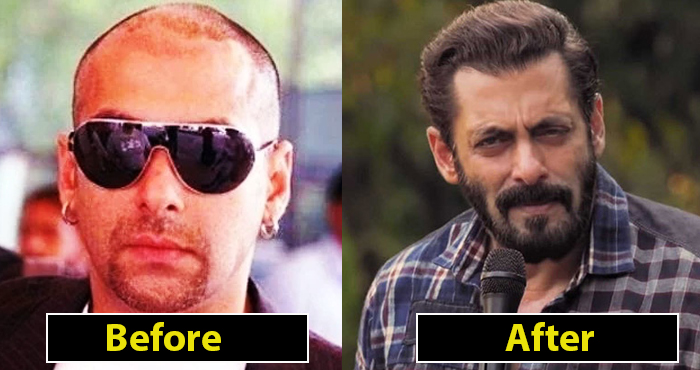 8 Bollywood Stars Who Made Huge Comebacks After Hair-transplant